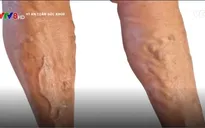 Tìm hiểu về căn bệnh suy giãn tĩnh mạch