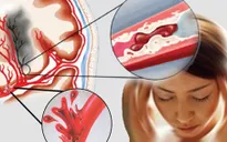 Tai biến mạch máu não: Dấu hiệu nhận biết và cách phòng bệnh