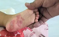 TP.HCM phòng bệnh tay chân miệng tại các trường mầm non