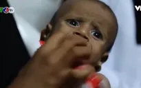 Bi kịch của những đứa trẻ tại Yemen