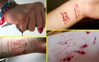 Tự làm đau bản thân là hành vi tự sát