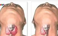Ung thư tuyến giáp – căn bệnh có thể chữa khỏi