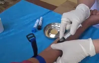 Nguyên nhân gây viêm cầu thận tại Nghệ An do liên cầu khuẩn nhóm A
