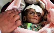 Trẻ em Yemen suy dinh dưỡng nghiêm trọng