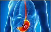 Việt Nam đứng thứ 18/20 nước có tỷ lệ ung thư dạ dày cao nhất thế giới