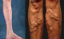 Bệnh suy tĩnh mạch có bao nhiêu cấp độ?