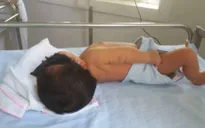 Trẻ sơ sinh vàng da phải thay máu hoàn toàn