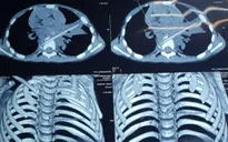 Bé trai 5 tuổi vỡ đốt sống, viêm phổi dai dẳng vì bị thanh nứa đâm