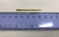Nuốt phải tăm trong lúc uống nước, nam thanh niên bị thủng dạ dày