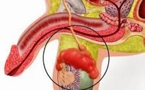 Nguyên nhân gây viêm mào tinh hoàn ở nam giới