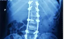 Kỹ thuật cắt V xương: cơ hội điều trị gù vẹo cột sống do thoái hóa