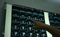 Cảnh giác với khối u trung thất khó phát hiện