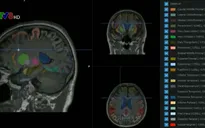 Hàn Quốc phát triển công nghệ chẩn đoán Alzheimer