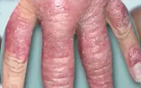 Tuần lễ khám miễn phí bệnh vảy nến tại Bình Định