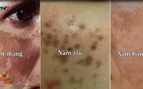 Điều trị nám da ở phụ nữ