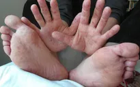 Phát hiện gen gây bệnh tay chân miệng