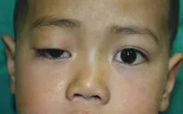 Điều trị sụp mi bằng kĩ thuật chuyển vạt cơ trán