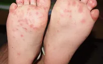 Cảnh báo gia tăng bệnh nhi mắc tay chân miệng