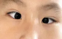 Mắt lé - bệnh về mắt gây giảm thị lực, thẩm mỹ
