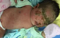 Trẻ 1 tháng tuổi viêm da chảy mủ toàn thân do tắm lá cây