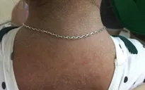 Bé gái bong tróc toàn thân do mắc hội chứng bong vảy da do tụ cầu