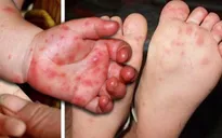 Bệnh tay chân miệng tăng đột biến tại Đồng Tháp