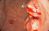 Ăn quá mặn người đàn ông bị ung thư dạ dày giai đoạn 3