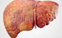Nam giới Việt mắc ung thư gan cao thứ 3 thế giới