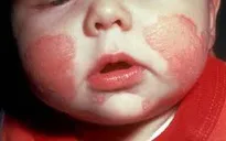 Chàm sữa - Bệnh lý ở trẻ nhỏ mỗi khi mùa đông đến