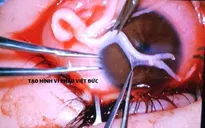 Nối sợi thần kinh 1mm vào giác mạc phục hồi cảm giác cho mắt