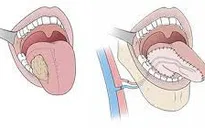 Dấu hiệu ung thư lưỡi mà bạn dễ dàng bỏ qua