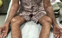 Tự ý dùng thuốc trị bệnh gout, cụ bà bị đỏ da toàn thân