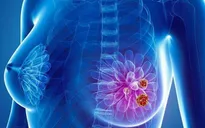Các dấu hiệu tái phát di căn bệnh ung thư vú