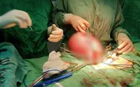 Sợ phẫu thuật, người phụ nữ phải mang khối u xơ tử cung 4,7kg