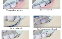 Infographics: Những điều bạn nên biết về răng khôn