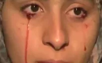 Kỳ lạ căn bệnh “khóc ra máu”