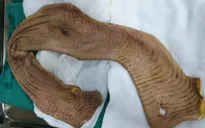 Nam thanh niên bị máy bóc vỏ gỗ lột toàn bộ da cánh tay