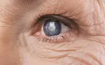 Bệnh võng mạc đái tháo đường: Hiểm họa ngầm gây mù lòa