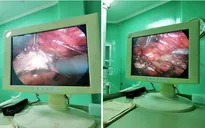 Nội soi tạo hình khúc nối bể thận - niệu quản cho bệnh nhân bị thận ứ nước