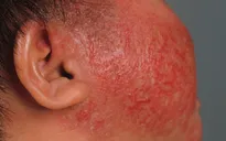 Cách chăm sóc da cho trẻ viêm da cơ địa