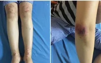 Trẻ xuất huyết dưới da toàn thân do mắc bệnh viêm mao mạch dị ứng