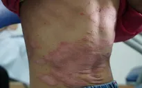 Những thách thức mà người bị bệnh vảy nến phải đối mặt