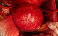 3 giờ căng thẳng cứu bệnh nhân phình động mạch chủ bụng dọa vỡ