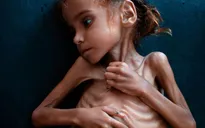 Em bé da bọc xương gây chấn động thế giới về nạn đói ở Yemen qua đời