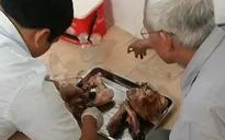 Bình Phước: Phát hiện ổ bệnh với 108 người nhiễm sán dây lợn