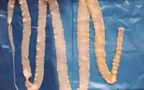 Sán lợn và cuộc "chu du" đáng sợ trong cơ thể con người