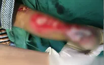Bé gái 2 tuổi bị nan xe máy bào thịt, cắt đứt gân chân