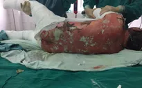 Hội chứng Lyell - Nhóm dị ứng thuốc chậm có thể đe dọa tính mạng