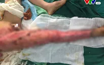 Sang Trung Quốc làm việc bé trai 12 tuổi bị tai nạn lóc da