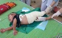 Đáng thương bé trai 2 tuổi người dân tộc ngã vào nồi nước sôi nguy kịch